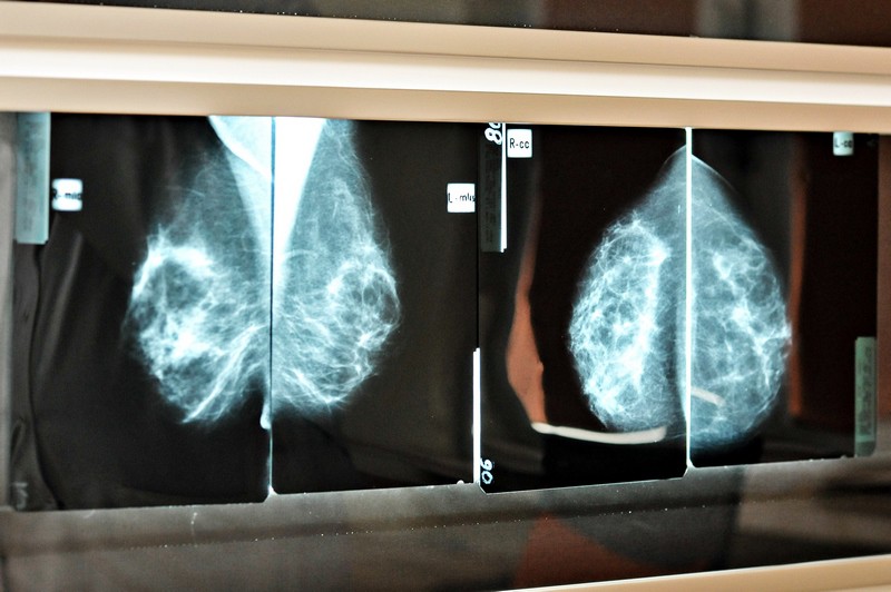 Elbląg, Wcześnie wykryty nowotwór piersi daje duże szanse na całkowite wyzdrowienie