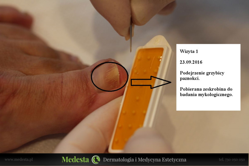 Laserowe usuwanie grzybicy paznokci również dla Gdańska zdjęcie nr 202419