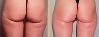 Salon Urody Marzeny Gross - Mezoterapia cz. 1