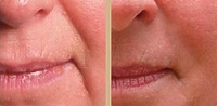 Salon Urody Marzeny Gross  - Mezoterapia cz. 2