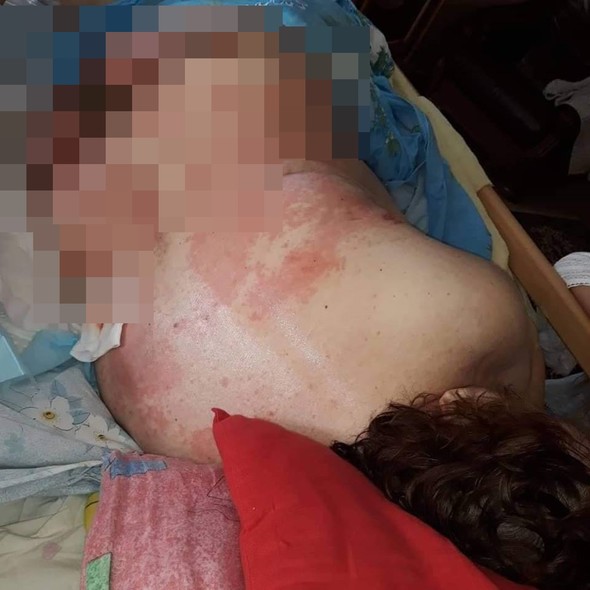 Elbląg, Do naszej redakcji córka pani Teresy wysłała kilkanaście zdjęć. Ze względu na ich drastyczność, rany pacjentki zostały przez nas zapikslowane Elbląg, Do naszej redakcji córka pani Teresy wysłała kilkanaście zdjęć. Ze względu na ich drastyczność, rany pacjentki zostały przez nas zapikslowane