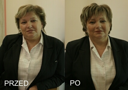 Elbląg, Joanna Nazarewicz przed i po zabiegu Elbląg, Joanna Nazarewicz przed i po zabiegu