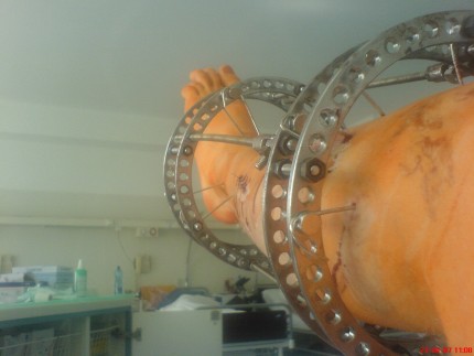 Elbląg, Noga Michała w aparacie Ilizarowa.