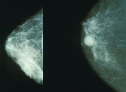 Elbląg, obraz mammorgaficzny normalny (po lewej) oraz rakowy (po prawej)
