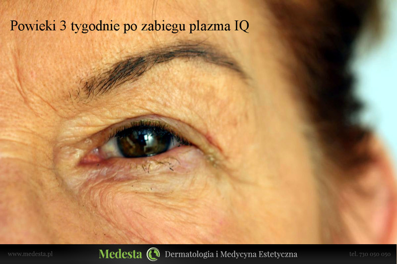 Rzeczywiste rezultaty zabiegów w Klinice Medesta zdjęcie nr 142973