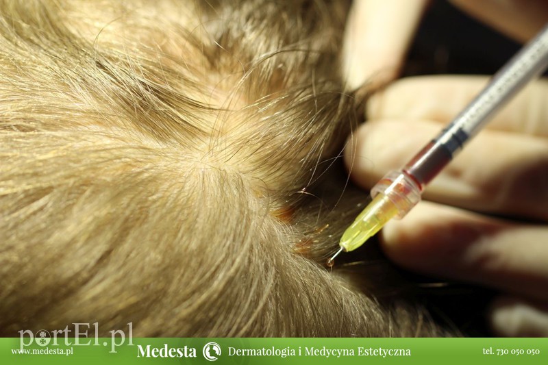 Anielska terapia dla skóry i włosów osoczem bogatopłytkowym Angel zdjęcie nr 147077