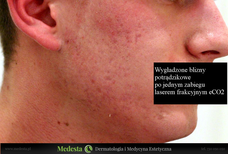 Usuwanie blizn i zmarszczek różnymi metodami zdjęcie nr 162590