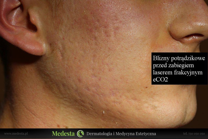 Usuwanie blizn i zmarszczek różnymi metodami zdjęcie nr 162588
