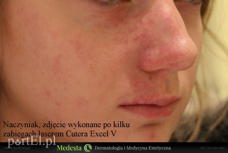 Jedyny w Elblągu laser na rumień i rozszerzone naczynka na twarzy i nogach zdjęcie nr 170863