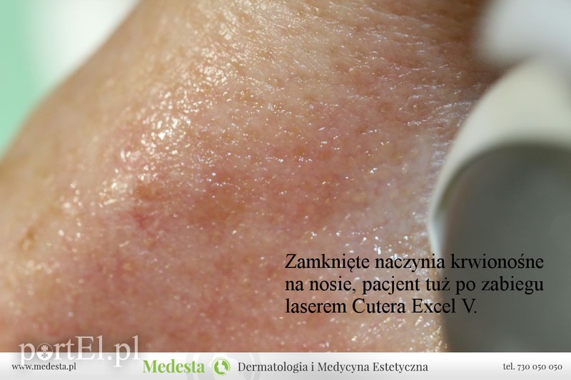 Jedyny w Elblągu laser na rumień i rozszerzone naczynka na twarzy i nogach zdjęcie nr 170865