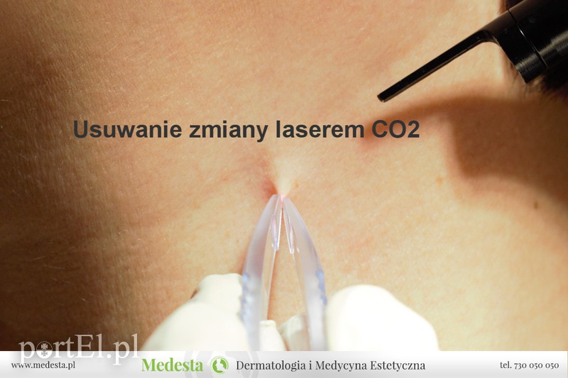 Laserowe usuwanie zmian okolic intymnych (brodawki, polipy, kłykciny) zdjęcie nr 172768
