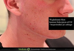 Usuwanie blizn i zmarszczek różnymi metodami