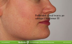 Usuwanie blizn i zmarszczek różnymi metodami