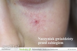 Jedyny w Elblągu laser na rumień i rozszerzone naczynka na twarzy i nogach
