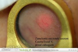 Jedyny w Elblągu laser na rumień i rozszerzone naczynka na twarzy i nogach