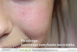 Jedyny w Elblągu laser na rumień i rozszerzone naczynka na twarzy i nogach