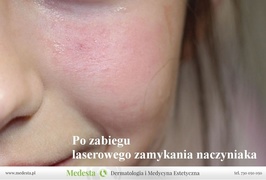 Skuteczne usuwanie pajączków laserem Cutera Excel V