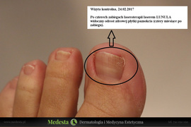 Laserowe usuwanie grzybicy paznokci również dla Gdańska